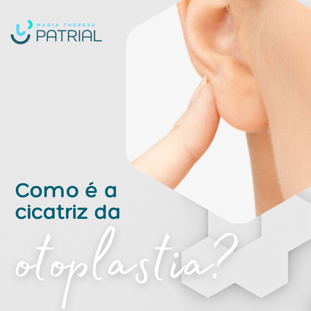 Orelha com otoplastia