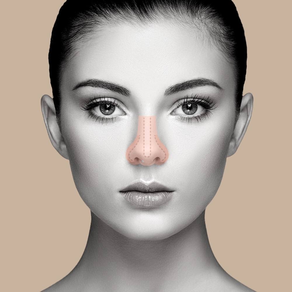 rinoplastia curitiba