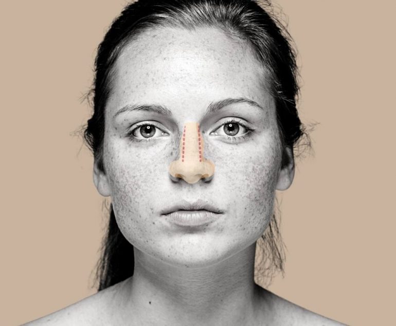 rinoplastia curitiba