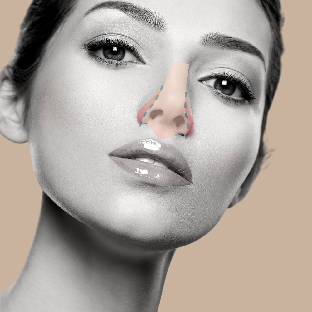 rinoplastia curitiba