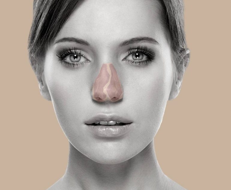 rinoplastia curitiba